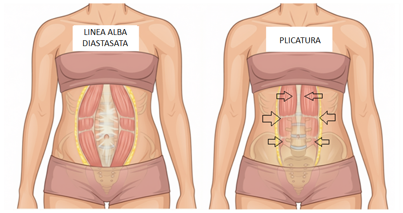 plicatura